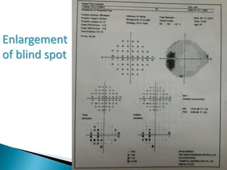 Enlargement
of blind spot
 