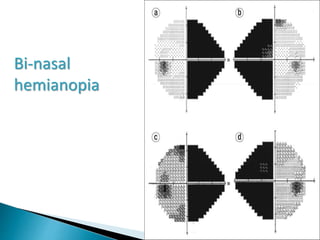 Bi-nasal
hemianopia
 