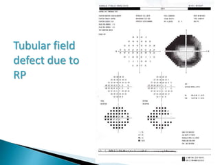 Tubular field
defect due to
RP
 