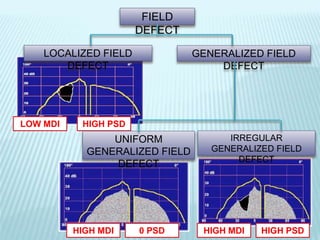 FIELD
DEFECT
LOCALIZED FIELD
DEFECT
GENERALIZED FIELD
DEFECT
LOW MDI HIGH PSD
UNIFORM
GENERALIZED FIELD
DEFECT
IRREGULAR
GENERALIZED FIELD
DEFECT
0 PSD HIGH PSDHIGH MDI HIGH MDI
 