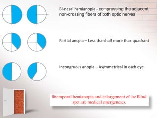 Bi-nasal hemianopia - compressing the adjacent
non-crossing fibers of both optic nerves
Partial anopia – Less than half more than quadrant
Incongruous anopia – Asymmetrical in each eye
Bitemporal hemianopia and enlargement of the Blind
spot are medical emergencies.
 