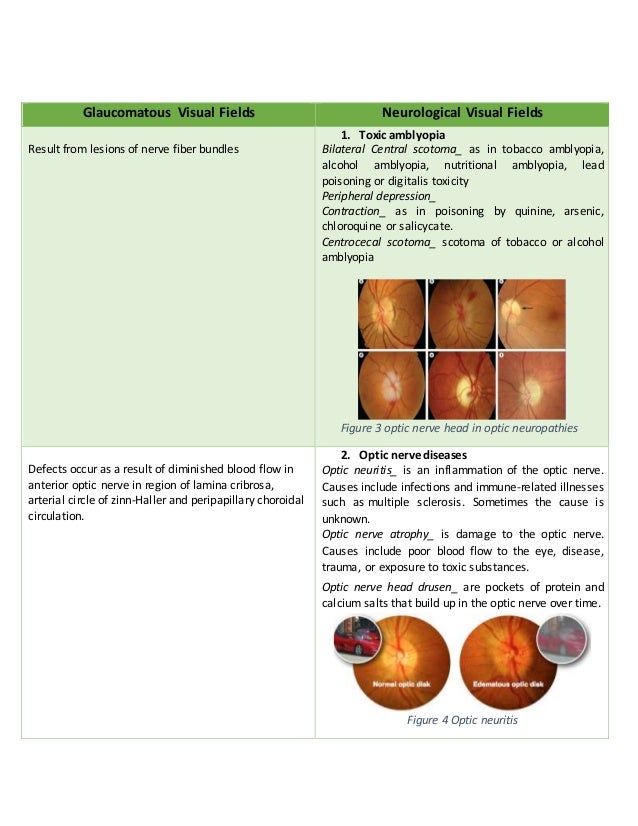 Glaucomatous Visual Fields Neurological Visual Fields
Result from lesions of nerve fiber bundles
1. Toxic amblyopia
Bilateral Central scotoma_ as in tobacco amblyopia,
alcohol amblyopia, nutritional amblyopia, lead
poisoning or digitalis toxicity
Peripheral depression_
Contraction_ as in poisoning by quinine, arsenic,
chloroquine or salicycate.
Centrocecal scotoma_ scotoma of tobacco or alcohol
amblyopia
Figure 3 optic nerve head in optic neuropathies
Defects occur as a result of diminished blood flow in
anterior optic nerve in region of lamina cribrosa,
arterial circle of zinn-Haller and peripapillary choroidal
circulation.
2. Optic nerve diseases
Optic neuritis_ is an inflammation of the optic nerve.
Causes include infections and immune-related illnesses
such as multiple sclerosis. Sometimes the cause is
unknown.
Optic nerve atrophy_ is damage to the optic nerve.
Causes include poor blood flow to the eye, disease,
trauma, or exposure to toxic substances.
Optic nerve head drusen_ are pockets of protein and
calcium salts that build up in the optic nerve over time.
Figure 4 Optic neuritis
 