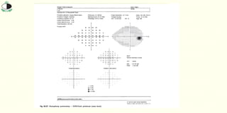 Visual Field Roll Paper Visual_Field_and_Visual_field_Screening-1.pptx