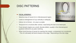 DISC PATTERNS
 FOCAL ATROPHY :
• Selective loss of neural rim in inferotemporal region.
• Leads to enlargement of cup vertically or obliquely.
• Inferior rim is thinner , rim area is smaller.
• Temporal rim is involved after vertical, nasal being the last to be destroyed.
• Focal atrophy begins as a small, discrete defect, usually in the inferotemporal
quadrant referred to as polar notching.
• When local thinning of neural rim reaches the margin, a sharpened rim is produced
. This rim ultimately will bend sharply at the edge : Bayoneting at the disc edge.
 