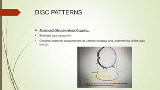 Disc At Risk Visual field assessment,optic nerve changes and retinal changes | PPTX