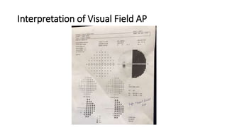 Interpretation of Visual Field AP
 