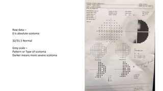 Raw data –
0 is absolute scotoma
32/31.5 Normal
Grey scale –
Pattern or Type of scotoma
Darker means more severe scotoma
 