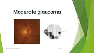VISUAL FIELD CHANGES IN GLAUCOMA by dr nanish.pptx
