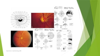 VISUAL FIELD CHANGES IN GLAUCOMA by dr nanish.pptx