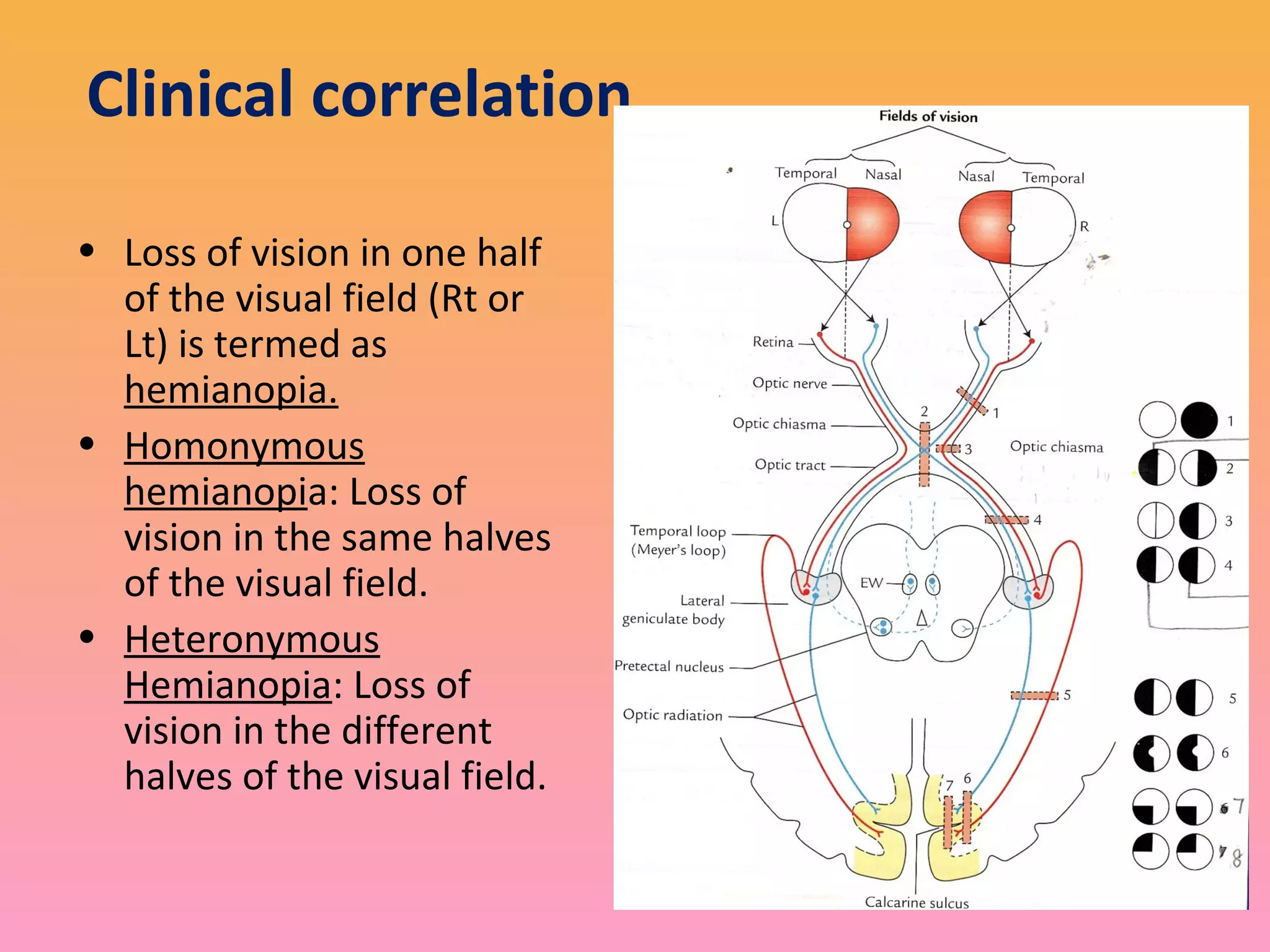 Clinical correlation
• Loss of vision in one half
of the visual field (Rt or
Lt) is termed as
hemianopia.
• Homonymous
hemianopia: Loss of
vision in the same halves
of the visual field.
• Heteronymous
Hemianopia: Loss of
vision in the different
halves of the visual field.
 