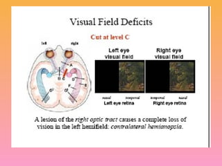 Visual field defects and light reflex | PPT