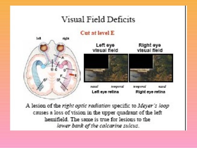 Visual field defects and light reflex