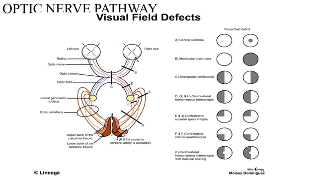 VISUAL FIELD ENHANCING TECHNIQUES FOR PATIENTS WITH HEMIANOPIA FIELD.pptx