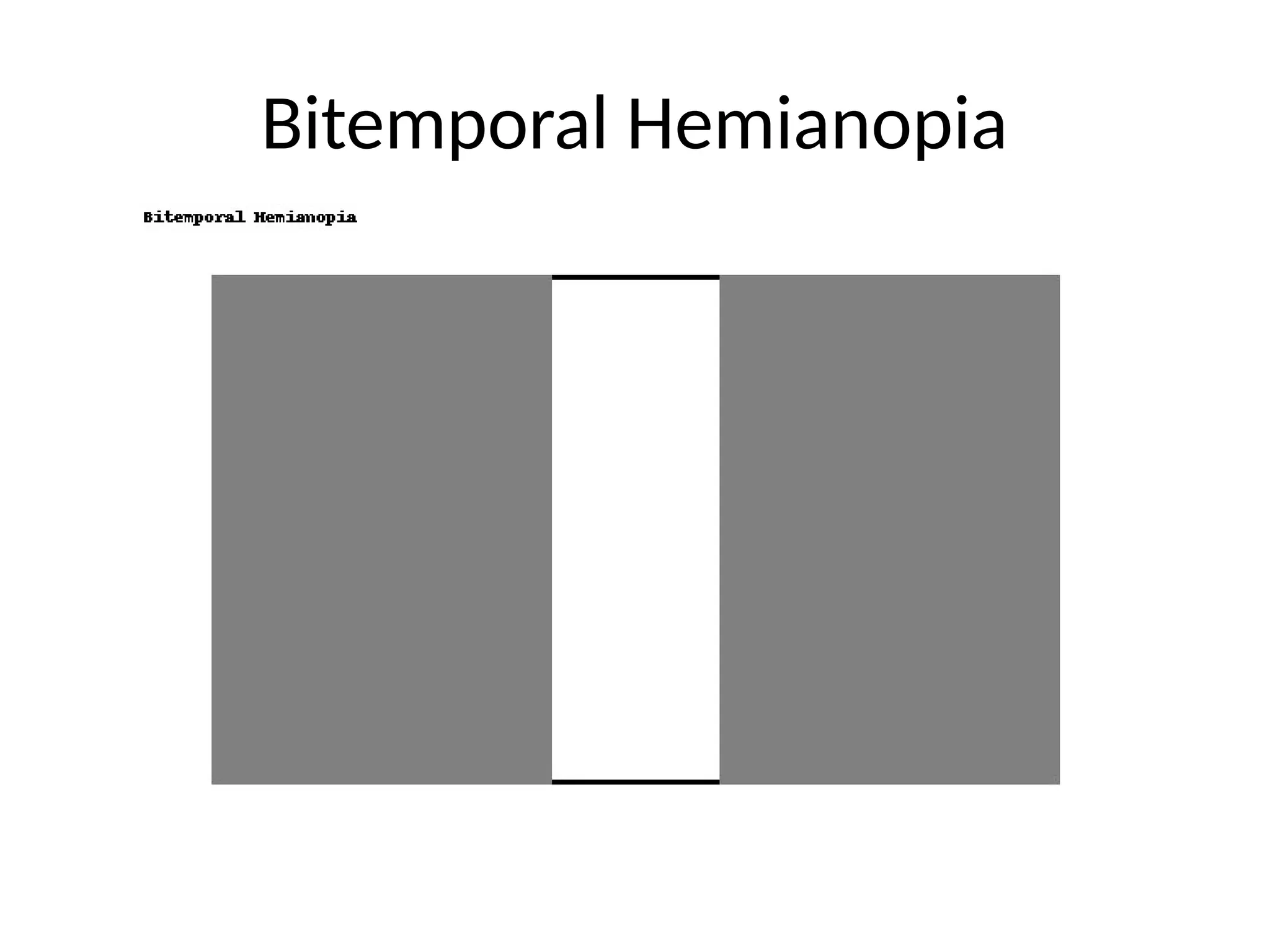Bitemporal Hemianopia
 