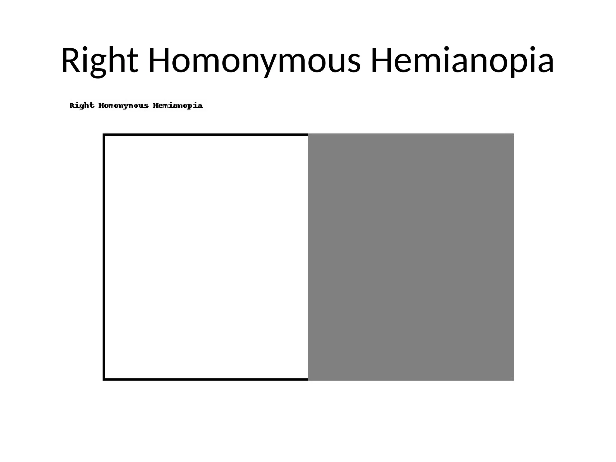 Right Homonymous Hemianopia
 