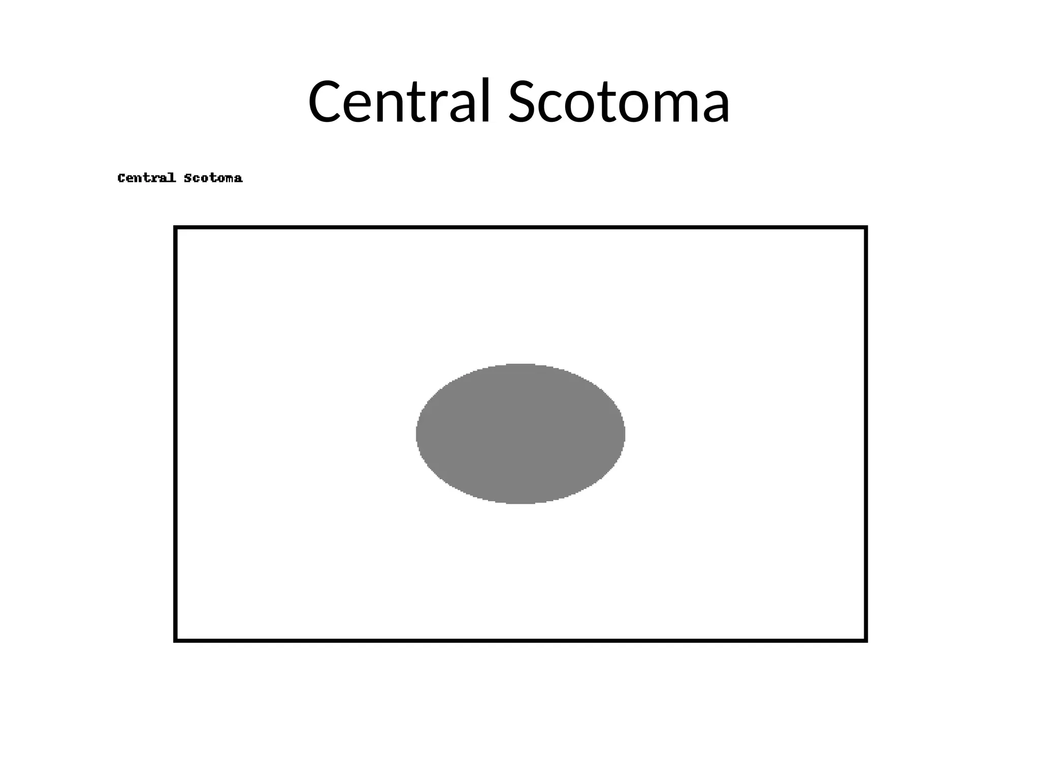 Central Scotoma
 