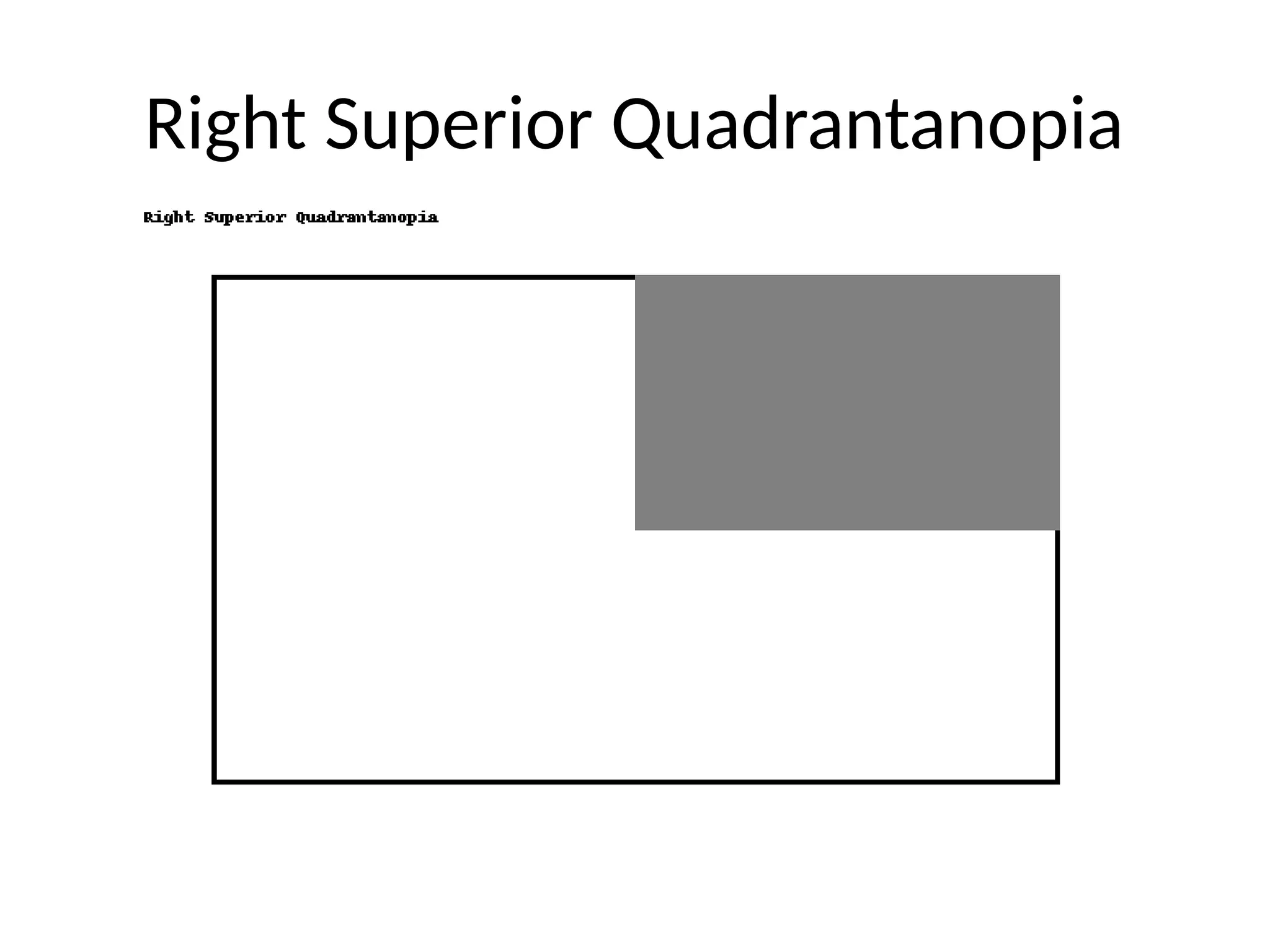 Right Superior Quadrantanopia
 