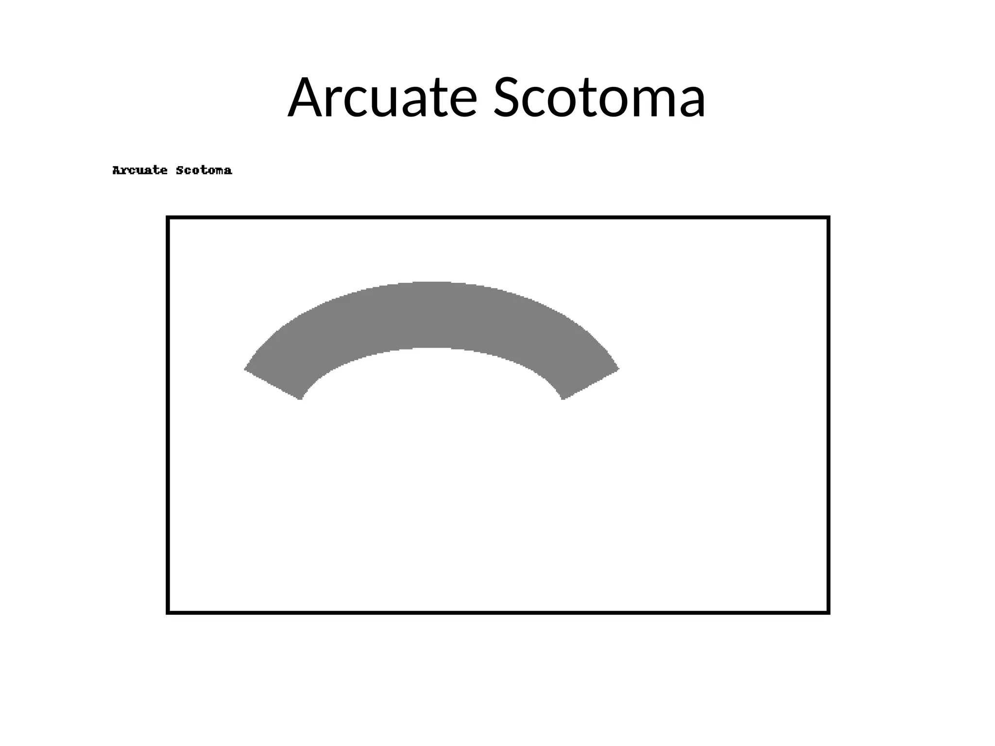 Arcuate Scotoma
 