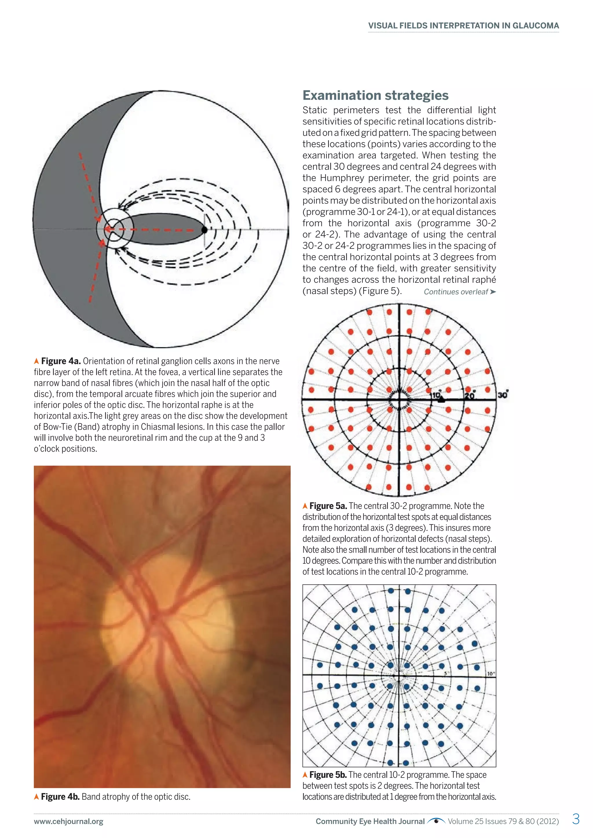 www.cehjournal.org Community Eye Health Journal Volume 25 Issues 79 & 80 (2012)
VISUAL FIELDS INTERPRETATION IN GLAUCOMA
3
Examination strategies
Static perimeters test the differential light
sensitivities of specific retinal locations distrib-
utedonafixedgridpattern.Thespacingbetween
these locations (points) varies according to the
examination area targeted. When testing the
central 30 degrees and central 24 degrees with
the Humphrey perimeter, the grid points are
spaced 6 degrees apart. The central horizontal
points may be distributed on the horizontal axis
(programme 30-1 or 24-1),or at equal distances
from the horizontal axis (programme 30-2
or 24-2). The advantage of using the central
30-2 or 24-2 programmes lies in the spacing of
the central horizontal points at 3 degrees from
the centre of the field, with greater sensitivity
to changes across the horizontal retinal raphé
(nasal steps) (Figure 5).
Figure 4b. Band atrophy of the optic disc.
Figure 5b.The central 10-2 programme.The space
between test spots is 2 degrees.The horizontal test
locationsaredistributedat1degreefromthehorizontalaxis.
Figure 5a. The central 30-2 programme. Note the
distributionofthehorizontaltestspotsatequaldistances
from the horizontal axis (3 degrees).This insures more
detailed exploration of horizontal defects (nasal steps).
Note also the small number of test locations in the central
10degrees.Comparethiswiththenumberanddistribution
of test locations in the central 10-2 programme.
Continues overleaf
Figure 4a. Orientation of retinal ganglion cells axons in the nerve
fibre layer of the left retina. At the fovea, a vertical line separates the
narrow band of nasal fibres (which join the nasal half of the optic
disc), from the temporal arcuate fibres which join the superior and
inferior poles of the optic disc. The horizontal raphe is at the
horizontal axis.The light grey areas on the disc show the development
of Bow-Tie (Band) atrophy in Chiasmal lesions. In this case the pallor
will involve both the neuroretinal rim and the cup at the 9 and 3
o’clock positions.
 