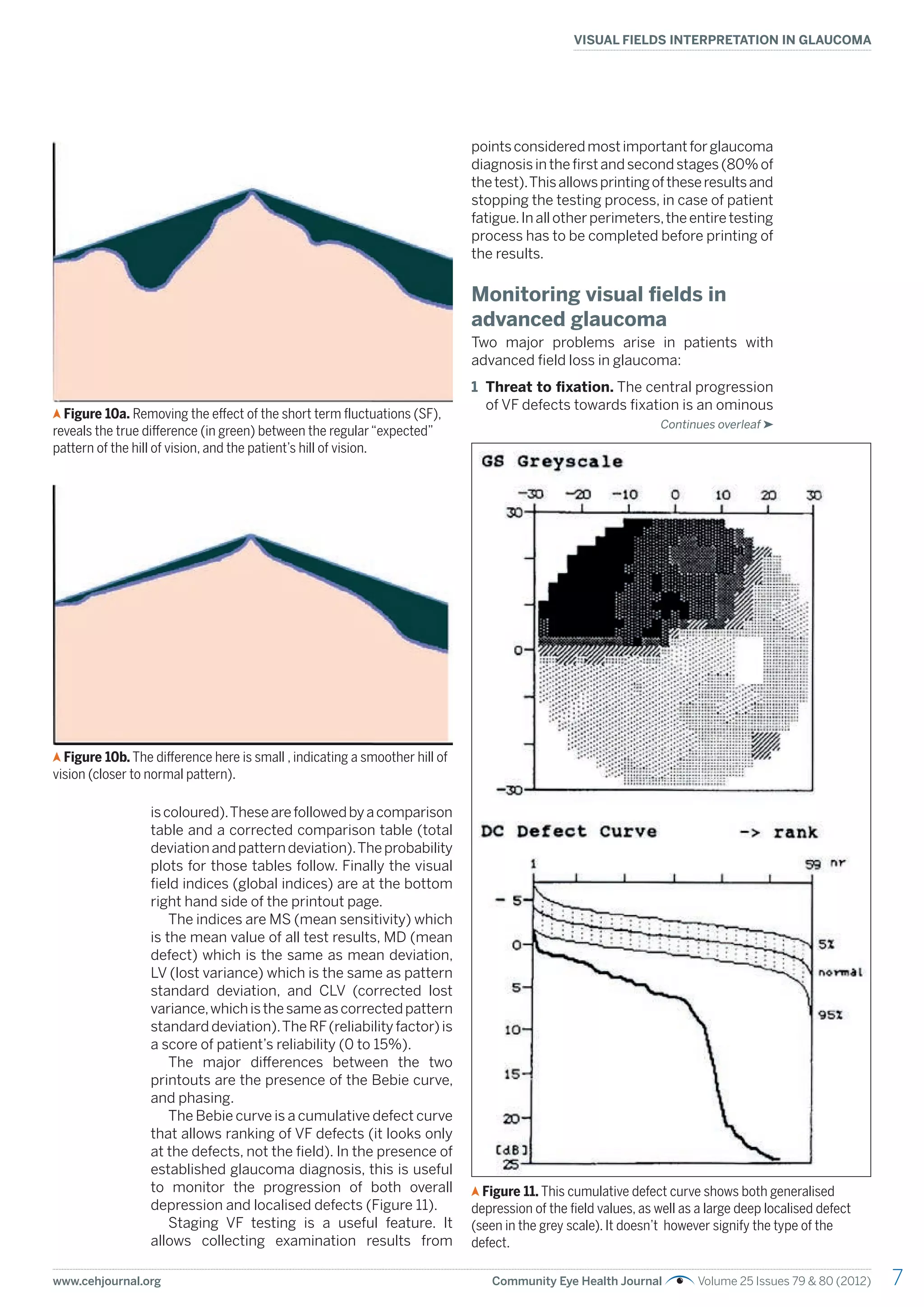 7
www.cehjournal.org Community Eye Health Journal Volume 25 Issues 79 & 80 (2012)
VISUAL FIELDS INTERPRETATION IN GLAUCOMA
iscoloured).Thesearefollowedbyacomparison
table and a corrected comparison table (total
deviationandpatterndeviation).Theprobability
plots for those tables follow. Finally the visual
field indices (global indices) are at the bottom
right hand side of the printout page.
The indices are MS (mean sensitivity) which
is the mean value of all test results, MD (mean
defect) which is the same as mean deviation,
LV (lost variance) which is the same as pattern
standard deviation, and CLV (corrected lost
variance,whichisthesameascorrectedpattern
standard deviation).The RF(reliability factor) is
a score of patient’s reliability (0 to 15%).
The major differences between the two
printouts are the presence of the Bebie curve,
and phasing.
The Bebie curve is a cumulative defect curve
that allows ranking of VF defects (it looks only
at the defects, not the field). In the presence of
established glaucoma diagnosis, this is useful
to monitor the progression of both overall
depression and localised defects (Figure 11).
Staging VF testing is a useful feature. It
allows collecting examination results from
pointsconsideredmostimportantforglaucoma
diagnosisinthefirstandsecondstages(80%of
thetest).Thisallowsprintingoftheseresultsand
stopping the testing process, in case of patient
fatigue.Inallotherperimeters,theentiretesting
process has to be completed before printing of
the results.
Monitoring visual fields in
advanced glaucoma
Two major problems arise in patients with
advanced field loss in glaucoma:
1 Threat to fixation. The central progression
of VF defects towards fixation is an ominous
Figure 10a. Removing the effect of the short term fluctuations (SF),
reveals the true difference (in green) between the regular“expected”
pattern of the hill of vision, and the patient’s hill of vision.
Figure 10b. The difference here is small , indicating a smoother hill of
vision (closer to normal pattern).
Figure 11. This cumulative defect curve shows both generalised
depression of the field values, as well as a large deep localised defect
(seen in the grey scale). It doesn’t however signify the type of the
defect.
Continues overleaf
 