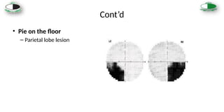 Visual_Field_Loss_and_its_patterns in human eye .pptx