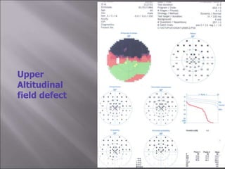 Visual Field presentation.nagla.ppt