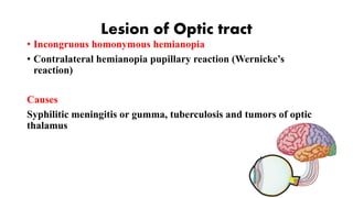 Lesion of Optic tract
• Incongruous homonymous hemianopia
• Contralateral hemianopia pupillary reaction (Wernicke’s
reaction)
Causes
Syphilitic meningitis or gumma, tuberculosis and tumors of optic
thalamus
 