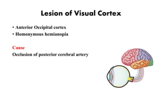 Lesion of Visual Cortex
• Anterior Occipital cortex
• Homonymous hemianopia
Cause
Occlusion of posterior cerebral artery
 