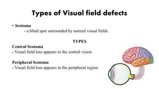 Types of Visual field defects
• Scotoma
- a blind spot surrounded by normal visual fields.
TYPES
Central Scotoma
- Visual field loss appears in the central vision
Peripheral Scotoma
- Visual field loss appears in the peripheral region
 