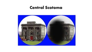 Central Scotoma
 
