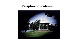 Peripheral Scotoma
 