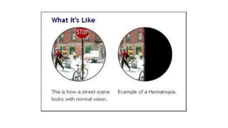 Visual field report | PPT | Free Download