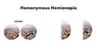 Homonymous Hemianopia
 