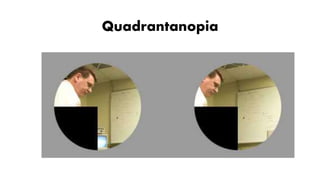 Quadrantanopia
 