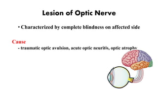 Lesion of Optic Nerve
• Characterized by complete blindness on affected side
Cause
- traumatic optic avulsion, acute optic neuritis, optic atrophy
 