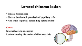 Lateral chiasma lesion
• Binasal hemianopia
• Binasal hemianopic paralysis of pupillary reflex
• Also leads to partial descending optic atrophy
Cause
Internal carotid aneurysm
Lesions causing distension of third ventricle
 
