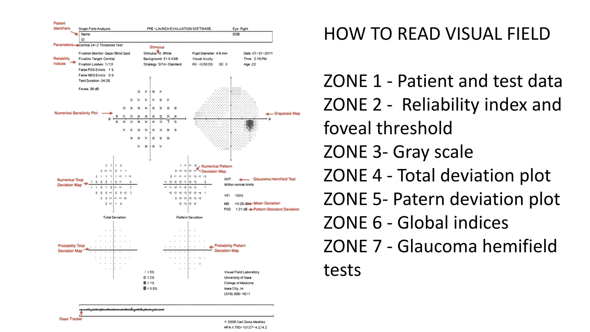 HOW TO READ VISUAL FIELD
ZONE 1 - Patient and test data
ZONE 2 - Reliability index and
foveal threshold
ZONE 3- Gray scale
ZONE 4 - Total deviation plot
ZONE 5- Patern deviation plot
ZONE 6 - Global indices
ZONE 7 - Glaucoma hemifield
tests
 
