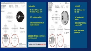Compass Visual Field VISUAL FIELDS . BASICS OF VISUAL FIELDS AND ITS INTERPRETATION | PPTX