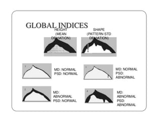 Interpretation of visual fields with special reference to octopus | PDF