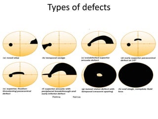 Interpretation of visual fields with special reference to octopus | PDF