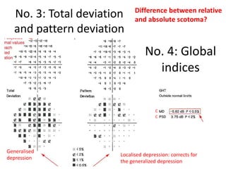 Interpretation of visual fields with special reference to octopus | PDF