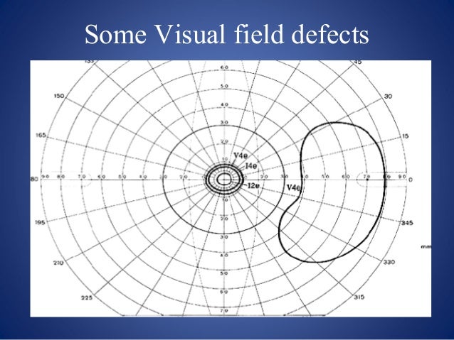 Visual Field Chart Interpretation
