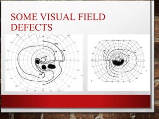 SOME VISUAL FIELD
DEFECTS
 