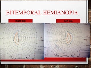 BITEMPORAL HEMIANOPIA
Right eye Left eye
 
