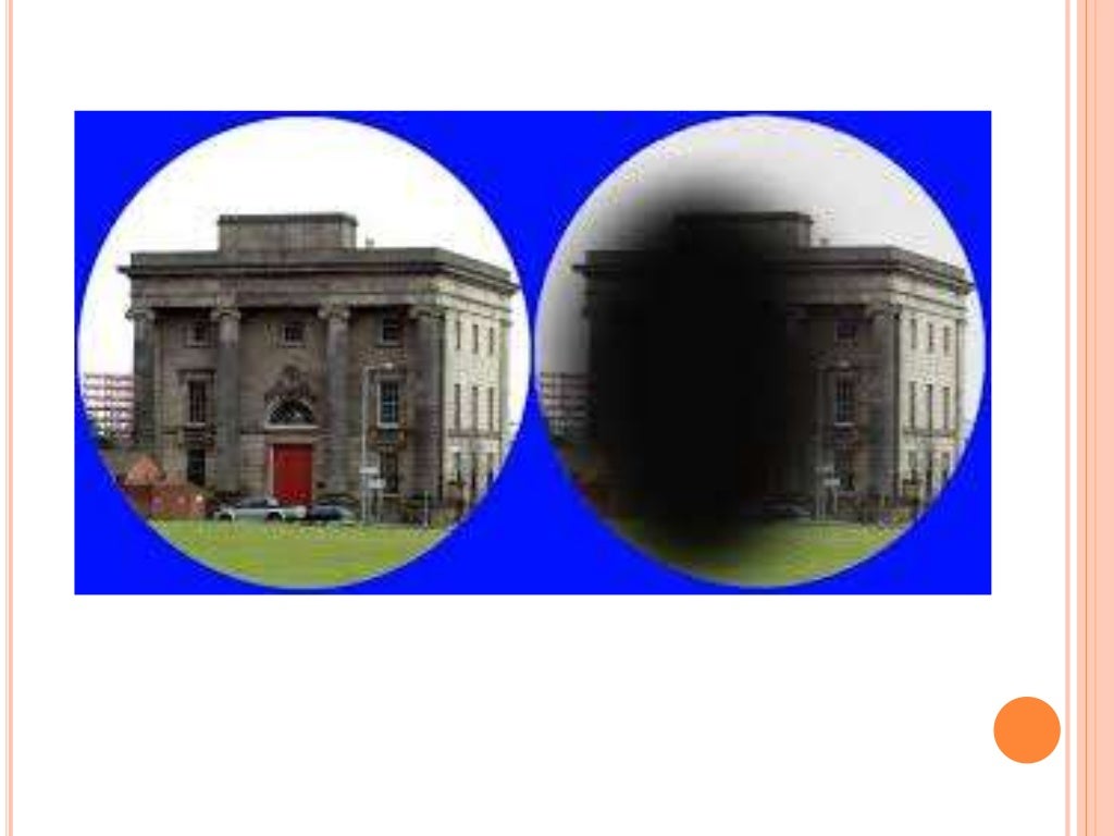 Visual hallucinations: Differential diagnosis & treatment