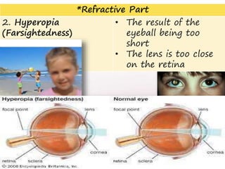 *Refractive Part
2. Hyperopia
(Farsightedness)
• The result of the
eyeball being too
short
• The lens is too close
on the retina
13
 