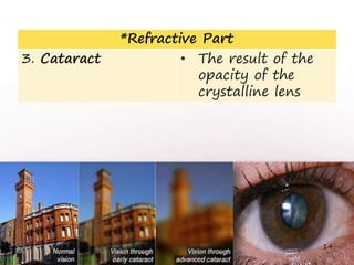 *Refractive Part
3. Cataract • The result of the
opacity of the
crystalline lens
14
 