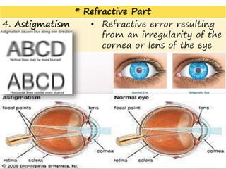 * Refractive Part
4. Astigmatism • Refractive error resulting
from an irregularity of the
cornea or lens of the eye
15
 
