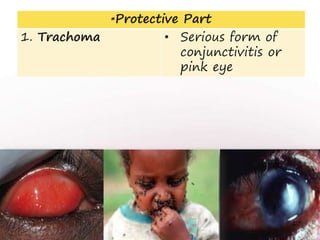 *Protective Part
1. Trachoma • Serious form of
conjunctivitis or
pink eye
17
 