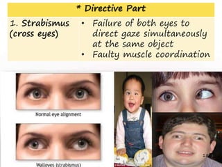 * Directive Part
1. Strabismus
(cross eyes)
• Failure of both eyes to
direct gaze simultaneously
at the same object
• Faulty muscle coordination
18
 